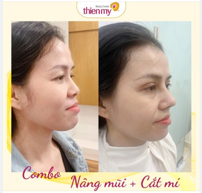 Combo nâng mũi + Cắt mí cải thiện vẻ đẹp cho khuôn mặt