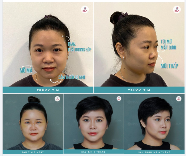 TRẦM TRỒ TRƯỚC THẦN THÁI ĐẸP TỰ NHIÊN CỦA CÔ GÁI SAU THẨM MỸ