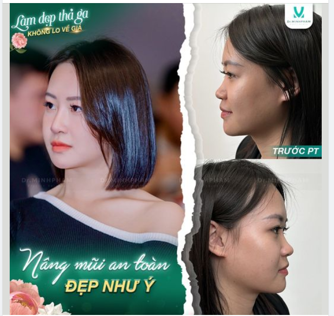 Cận cảnh nhan sắc vượt trội của khách hàng Dr Minh Phạm sau 3 tháng nâng mũi