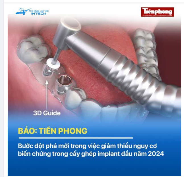 Báo Tiền Phong Bước đột phá mới trong việc giảm thiểu nguy cơ biến chứng trong cấy ghép implant đầu năm 2024