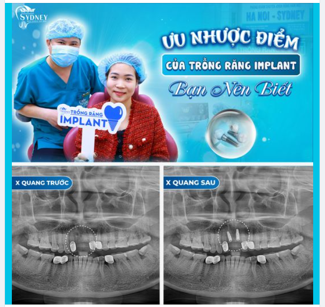 ƯU NHƯỢC ĐIỂM KHI TRỒNG RĂNG IMPLANT BẠN NÊN BIẾT