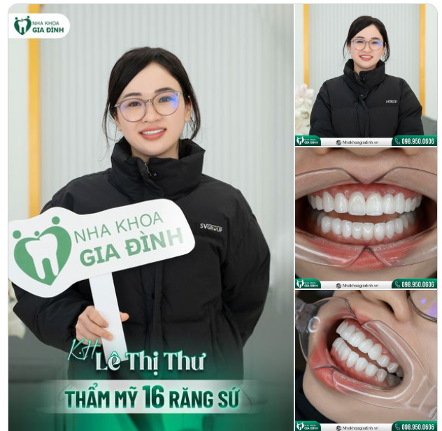 Chị Lê Thị Thư cũng đắn đo, suy nghĩ một thời gian khá dài rồi mới quyết định đi làm lại hàm răng nhiều khuyết điểm của bản thân.