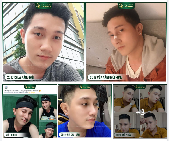 Hành trình 5 năm nâng mũi của chàng hotboy nhà Tuấn Linh!!