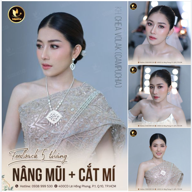 FEEDBACK SAU 5 THÁNG: NÂNG MŨI + CẮT MÍ