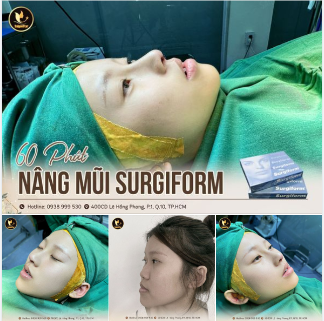 60 PHÚT NÂNG MŨI SURGIFORM, TẠO HÌNH DÁNG MŨI ĐẸP TỰ NHIÊN