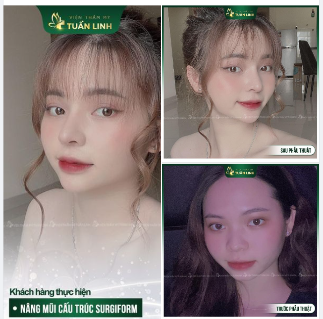 ĐẸP NGẤT NGÂY MŨI CẤU TRÚC SỤN SURGIFORM!!