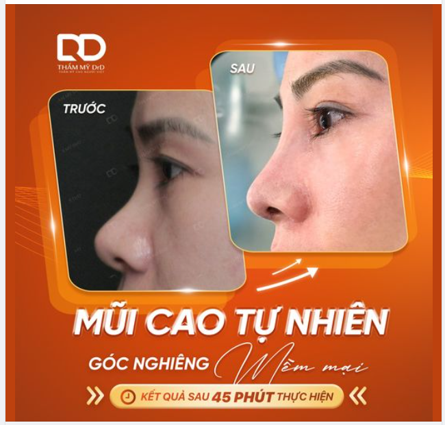 "Thành quả" sau 45 phút thực hiện Nâng mũi Perfect Dform
