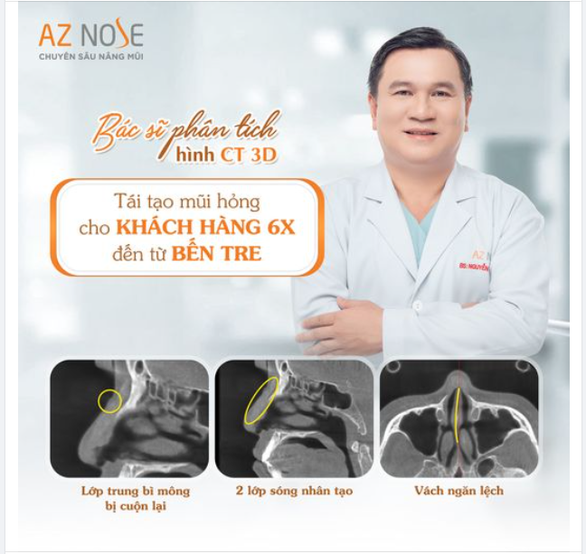 Tái tạo mũi h.ỏng cho khách hàng 6X Bến Tre