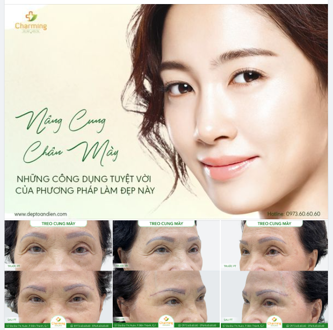 NÂNG CUNG MÀY VÀ NHỮNG CÔNG DỤNG TUYỆT VỜI CỦA PHƯƠNG PHÁP LÀM ĐẸP NÀY