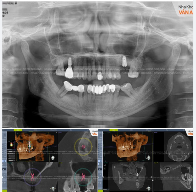Tiêu xương có trồng được răng Implant không?
