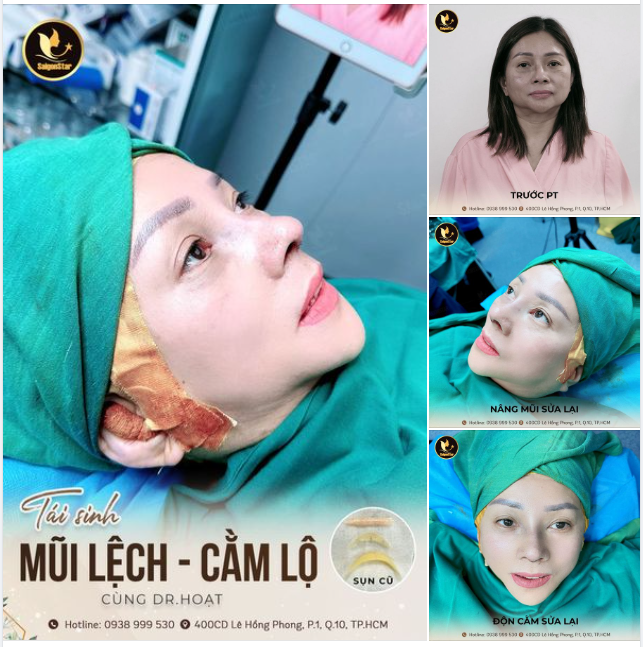 TÁI SINH MŨI LỆCH – CẰM LỘ CÙNG DR. HOẠT