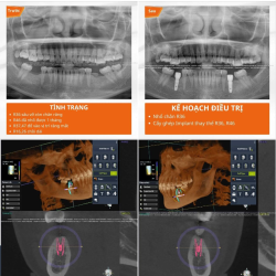 Trồng răng Implant - Phục hồi răng sâu hỏng nặng