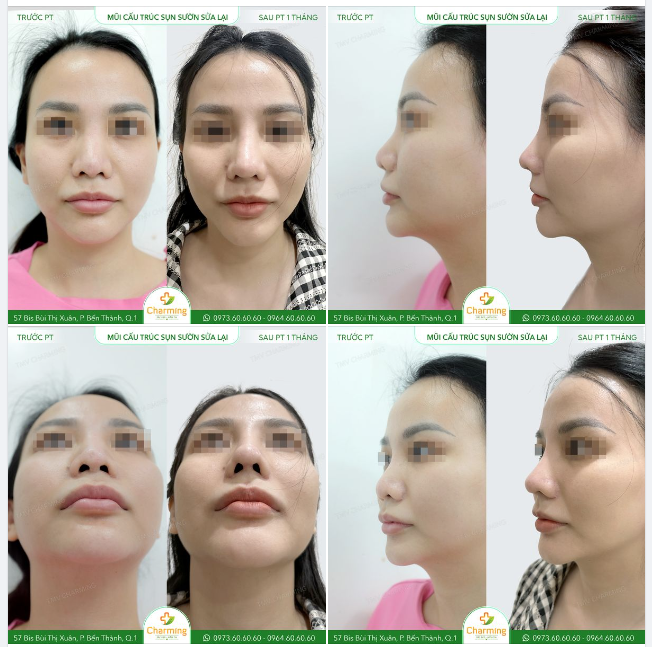 Nhìn chiếc mũi cũ thấp mà sóng mũi lệch nặng, khó ai có thể tin được đây là chiếc mũi đã từng được... nâng mũi rồi