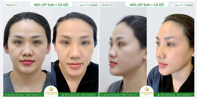 Chiếc mũi thấp và gồ khiến bạn khách không hài lòng với khuôn mặt của mình.