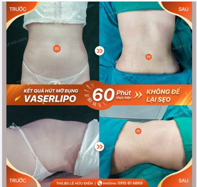 Chỉ 60 phút, gia nhập ngay TEAM bụng nhỏ eo thon. Mùa của những vòng eo con kiến đây rồi.