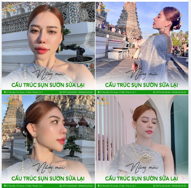 Nhìn nàng khách như thế này có ai nghĩ mũi nàng đã từng nâng mũi trước đó và đã đến Charming để thực hiện nâng mũi cấu trục sụn sườn sửa lại không?