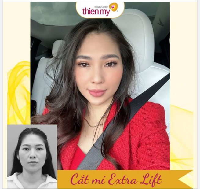 Feedback cắt mí uy tín luôn ạ. ƯU ĐIỂM VƯỢT TRỘI CẮT MÍ TẠI THIỆN MỸ