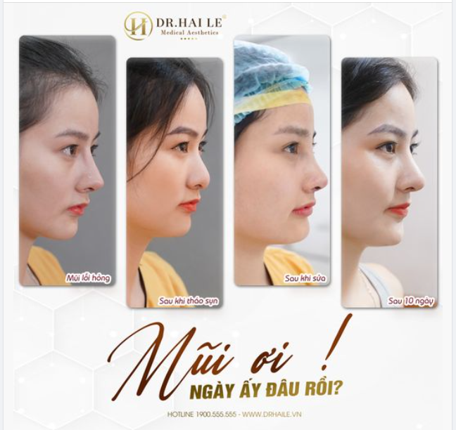 Mũi ơi ngày ấy đâu rồi