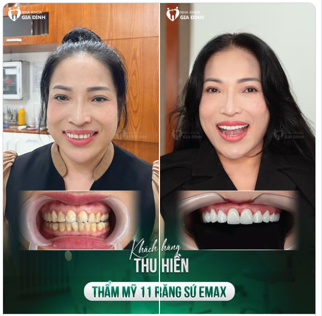 ĐÃ TỰ TIN NAY CÀNG TỰ TIN HƠN NHỜ THAY ĐỔI HÀM RĂNG