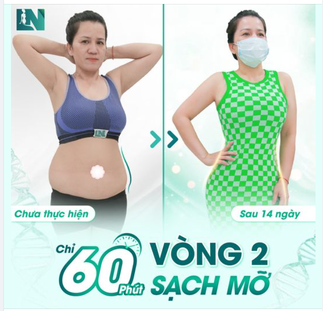EO THON, DÁNG GỌN TRONG TÍCH TẮC | H.Ú.T MỠ KHÔNG CĂNG CẮT DA