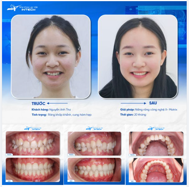XÓA BỎ NỖI “ÁM ẢNH” SUỐT 20 NĂM CHỈ TRONG 20 THÁNG - BÁC SĨ ĐÃ LÀM THẾ NÀO?