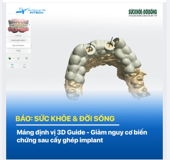 Báo Sức khỏe Đời sống] Máng định vị 3D Guide - Giảm nguy cơ biến chứng sau cấy ghép implant