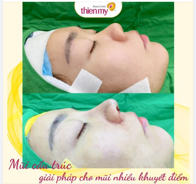 Một chiếc mũi không hài hòa với toàn thể gương mặt cũng khiến cho người phụ nữ không tự tin về nhan sắc trước mắt mọi người.