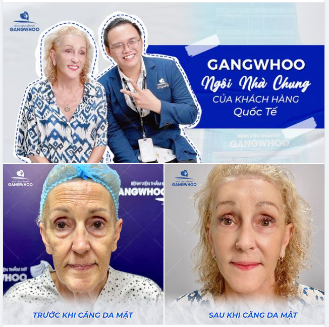 Căng da mặt - Cầu nối gán kết các khách hàng quốc tế  đến ngôi nhà chung có tên Gangwhoo