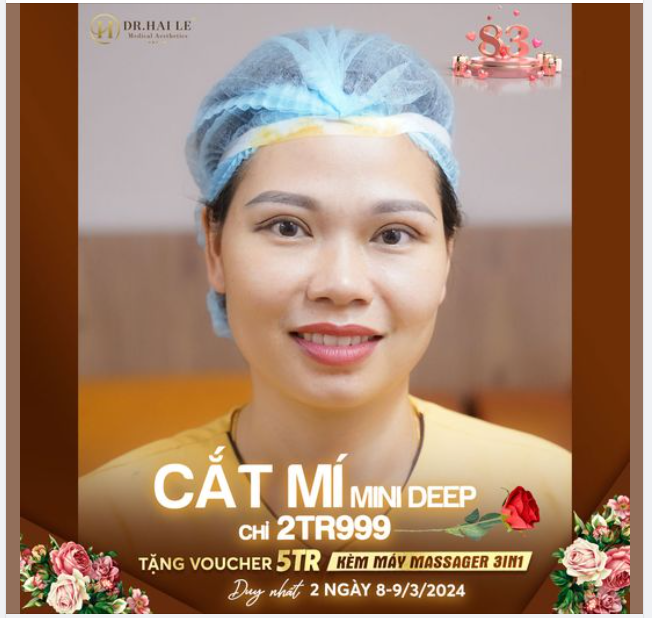 Siêu khủng cắt mí MiniDeep chỉ 2tr999