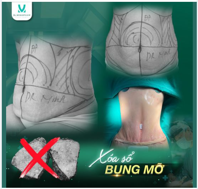 Hút mỡ siết eo tại Dr. Minh Phạm:giải pháp hoàn hảo cho vòng eo thon gọn, quyến rũ