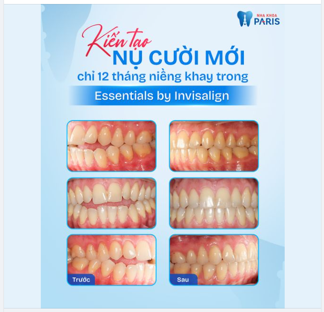 12 THÁNG ĐIỀU TRỊ KHỚP CẮN HỞ VỚI KHAY TRONG INVISALIGN ESSENTIALS