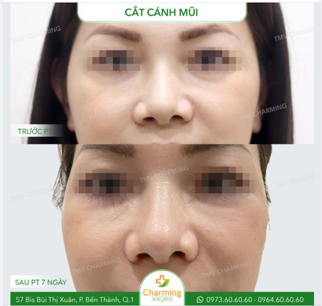 Mũi cũ có chiều ngang to bè hơn nhiều, với 2 lỗ mũi bên cao bên thấp. Đúng là việc để hai lỗ mũi đều nhau là chuyện bất khả thi, nhưng cái gì quá thì cũng hông được