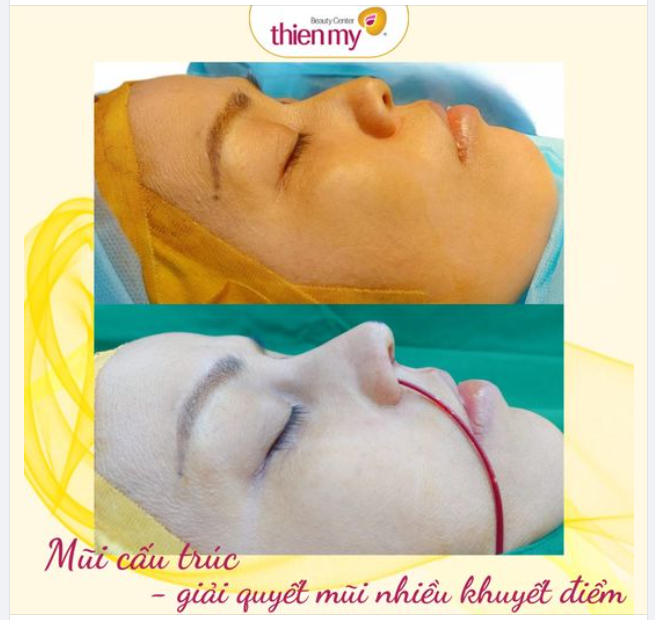 Nâng mũi cấu trúc-cải thiện mũi nhiều khuyết điểm