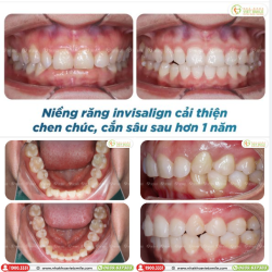 NIỀNG RĂNG INVISALIGN NHẬN HÀM RĂNG MÊ LY