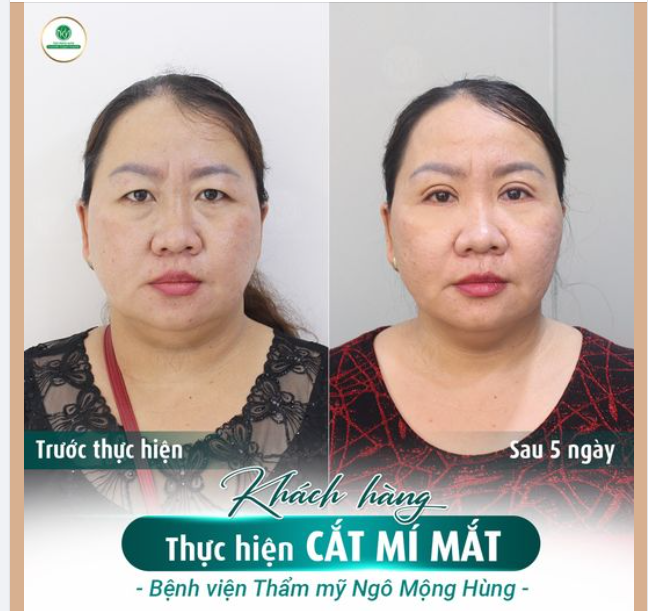 LẤY LẠI VẺ TRẺ TRUNG CHO ĐÔI MẮT BẰNG PHƯƠNG PHÁP CẮT MÍ MẮT TẠI BVTM NGÔ MỘNG HÙNG