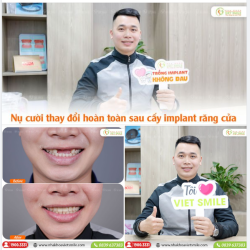 RĂNG IMPLANT THẨM MỸ NHƯ RĂNG THẬT