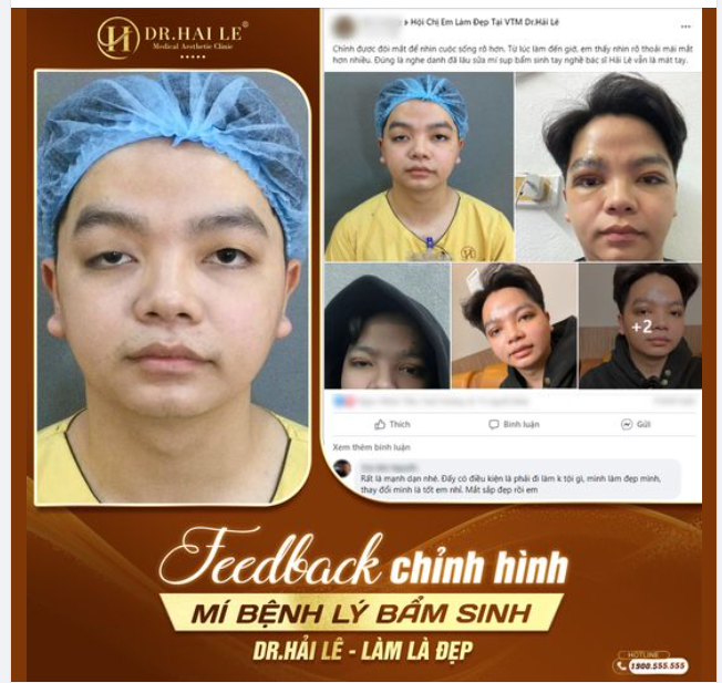 Feedbck chỉnh hình mí bệnh lý bẩm sinh Dr Hải Lê - Làm là đẹp
