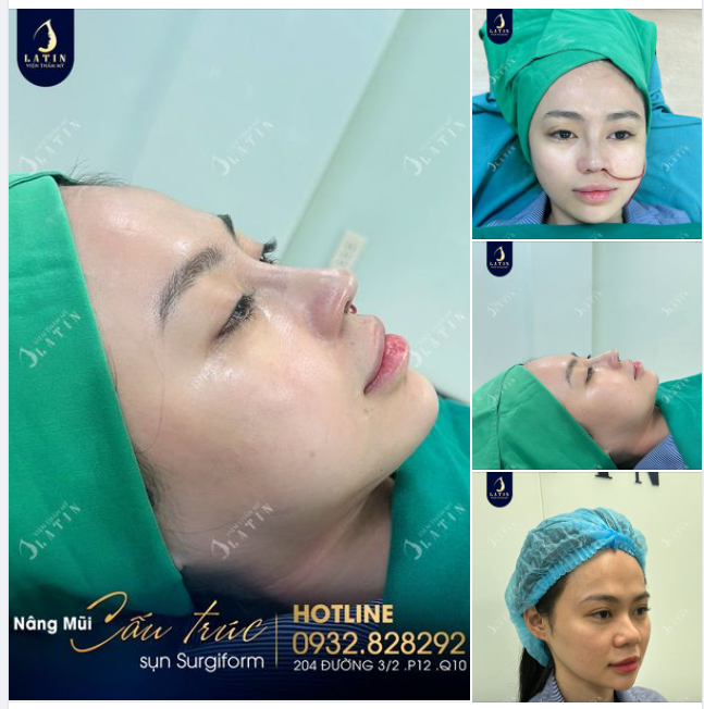 Mũi lệch vách ngăn, đầu mũi to, sóng mũi thấp thì làm như thế nào