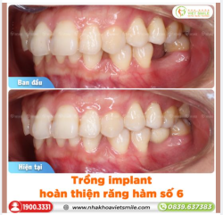 TRỒNG IMPLANT HOÀN THIỆN HÀM RĂNG, KHẮC PHỤC RĂNG HÀM SỐ 6 MẤT