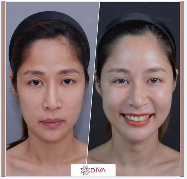 TIÊM MỠ MẶT – TRẺ HÓA GƯƠNG MẶT HỐC HÁC, THIẾU SỨC SỐNG