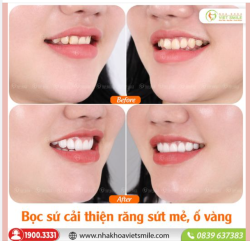 BỌC SỨ CẢI THIỆN RĂNG SỨT MẺ, Ố VÀNG