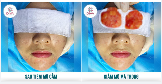 BÍ QUYẾT ĐỂ VÙNG MẶT DƯỚI SĂN CHẮC, THON GỌN