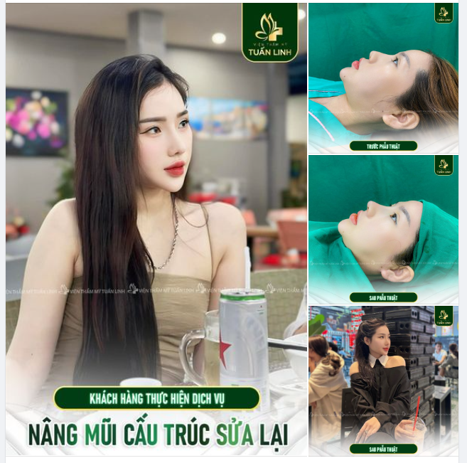Đã từng nâng mũi nhưng dáng mũi đơ thô, mũi ngắn, mũi nhọn, mũi hếch.. Xem ngay pic này nha!