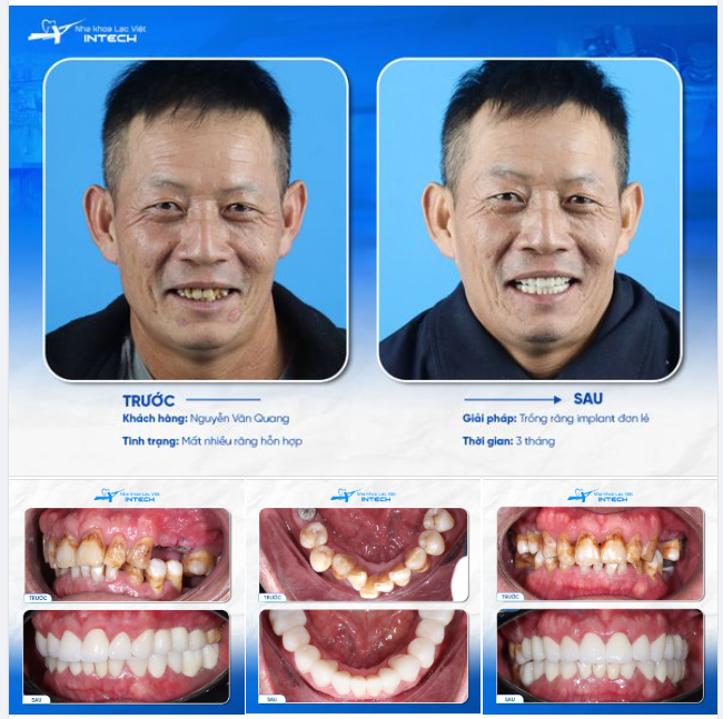 LÝ DO VIỆT KIỀU ÚC VỀ VIỆT NAM TRỒNG RĂNG IMPLANT LÀ GÌ?