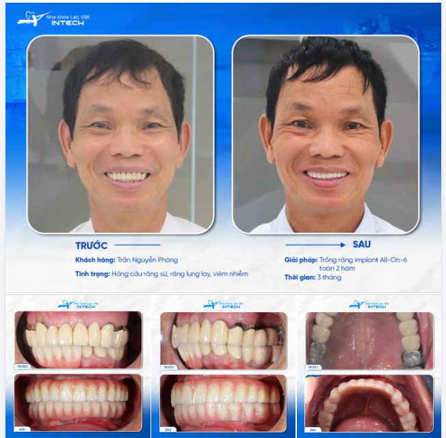 KHỔ SỞ VÌ CẦU RĂNG SỨ, U70 "HỒI SINH" HÀM RĂNG NGOẠN MỤC NHỜ CÔNG NGHỆ TRỒNG RĂNG IMPLANT TẠI LẠC VIỆT INTECH