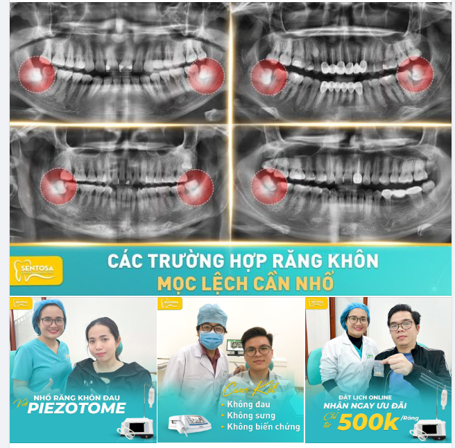 NHỔ RĂNG KHÔN MỌC LỆCH TỪ 500.000 VND/RĂNG