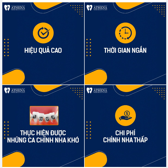 Niềng răng mắc cài kim loại truyền thống