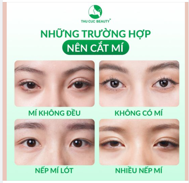 Những trường hợp nào nên cắt mí?