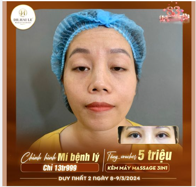 2 ngày vàng chỉnh hình mí bẩm sinh Dr Hải Lê HCM chỉ 13tr999