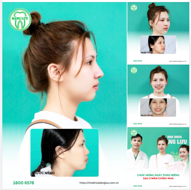 GÓC NGHIÊNG THẦN THÁNH SAU NIỀNG RĂNG LÀ CÓ THẬT